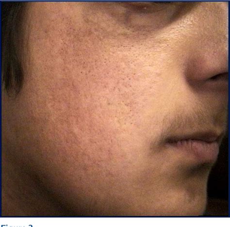 Figure 2 from Parry-Romberg syndrome. | Semantic Scholar