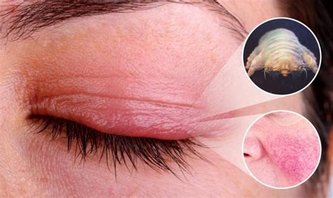 Эффективность препаратов «Stop demodex» в терапии демодекоза век - demodex