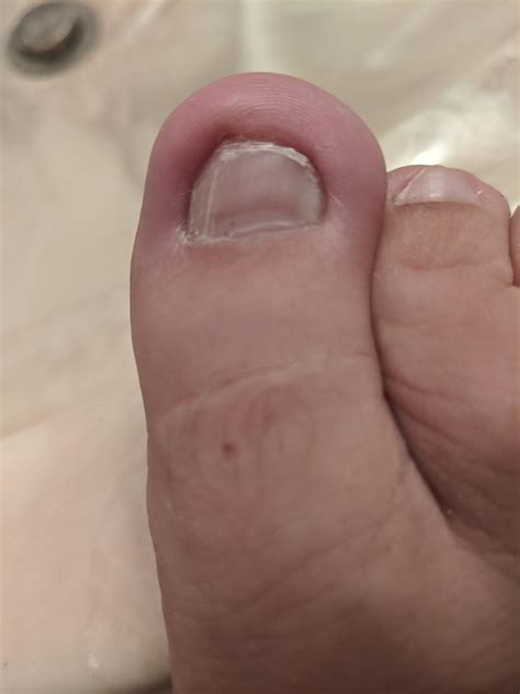 [Trigger Warning] My toenail is ingrown because after years of picking
