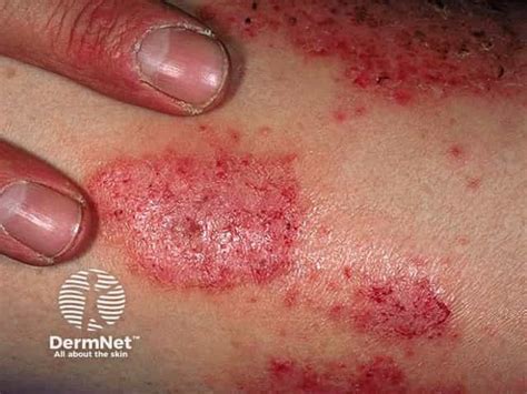 nummular dermatitis discoid eczema image