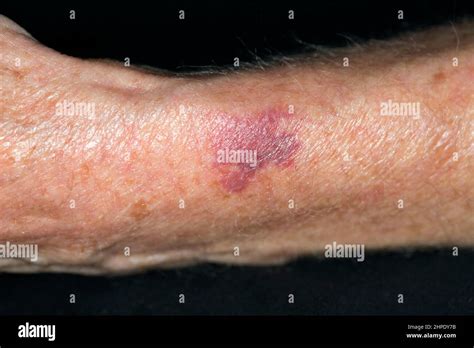 Purpura skin hi-res stock photography and images - Alamy