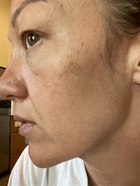 how to get rid of face sunspots 4