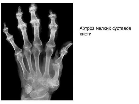 Рентгенодиагностика артроза мелких суставов кистей Практикум для врачей