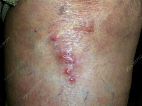 CREST syndrome - Stock Image - C056/5376 - Science Photo Library