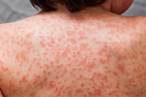 Viral Rash