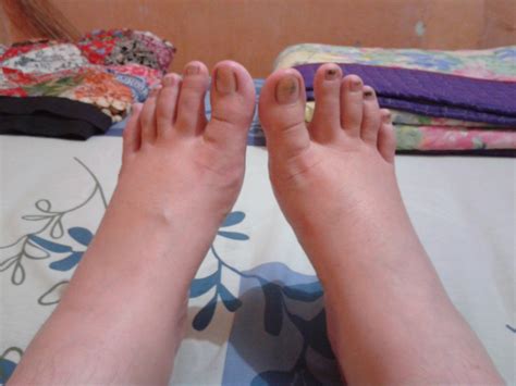 petua  hilangkan kematu  tumit kaki petua nenek panduan