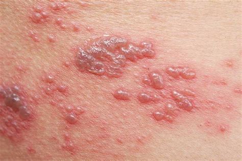 What Causes Shingles (Herpes Zoster)? | Ausmed