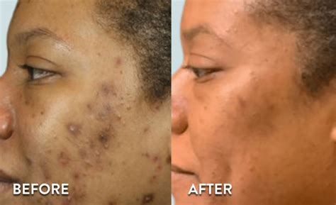 SkinCeuticals Peels Before & After Photos - WIFH