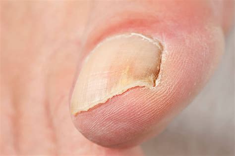 630+ Manchas Blancas En Las Uñas De Los Pies Fotografías de stock ...