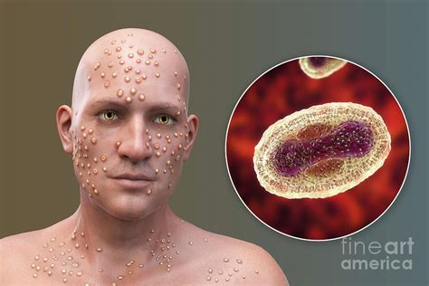 Smallpox Virus Infection #2 Photograph by Science Photo Library ...