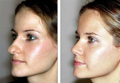 Rhinoplasty Nose Surgery Fullerton Ca Before After Photo | My XXX Hot Girl