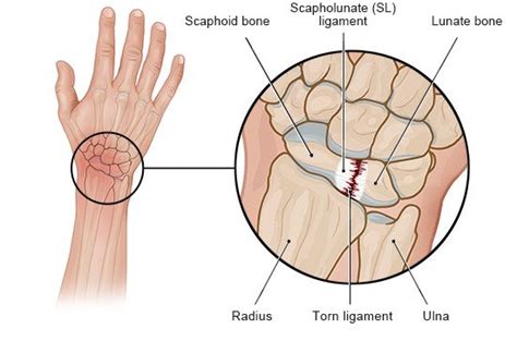 Wrist Ligament Injury