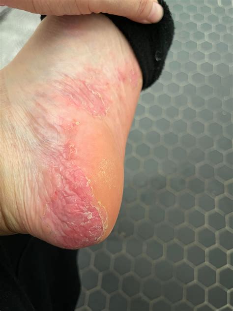 Palmoplantar Pustular Psoriasis or Dyshidrotic eczema? : r/Psoriasis