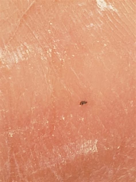 Wasp Sting: Reaction, Treatment, Remedy and Black Dot from a Wasp Sting