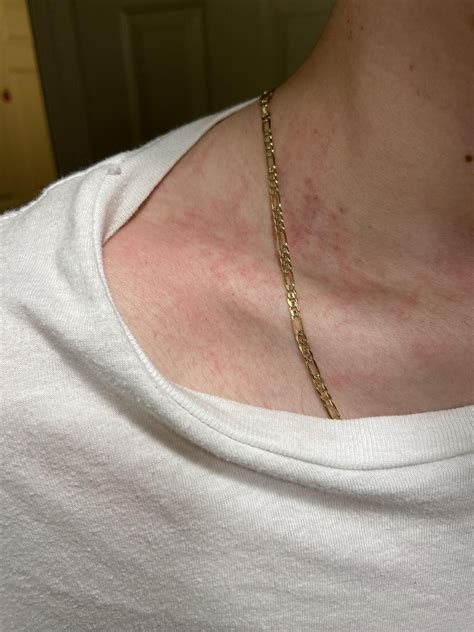 Itchy/red skin help pls : r/DermatologyQuestions