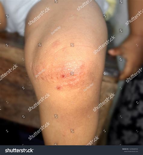 Tinea Corporis Fungal Skin Infection Lower Stockfoto 1429668554