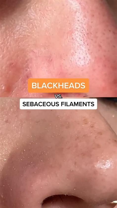 Blackheads vs. Sebaceous Filaments | Dermatological skin care, Healthy skin, Skin care treatments