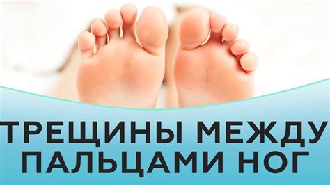 Трещины между пальцами ног - YouTube