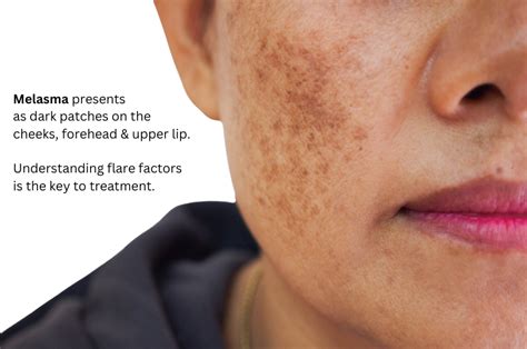 australias  melasma treatments  melasma clinic