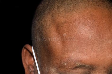 Edema Na Cabeça Após Queda - Edema Nella Regione Temporale Della Testa Fotografia Stock - Immagine ...