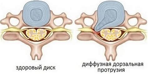 Протрузии дисков - Лечение, симптомы и профилактика протрузии ...