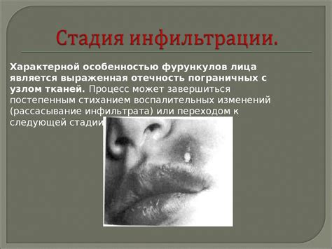 Фурункул, карбункул лица. Рожистое воспаление - презентация онлайн