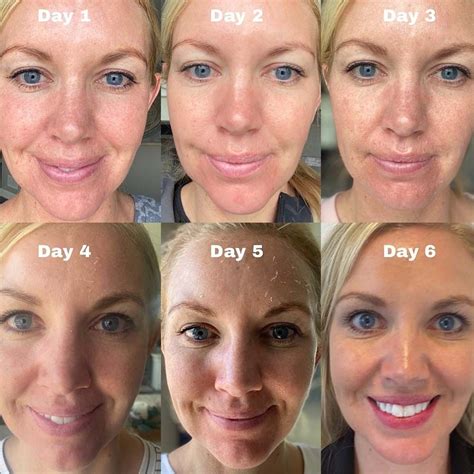 Chemical peel types safety aftercare cost more – Artofit