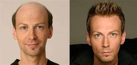 before_after_7 - Cincinnati Hair Loss | Men & Women Hair Loss Solutions ...