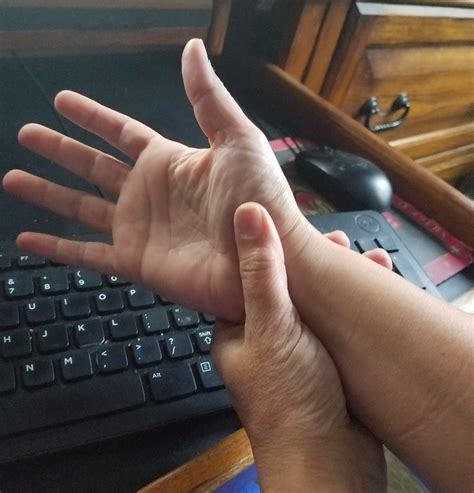 Huntington Beach Chiropractor - carpal tunnel