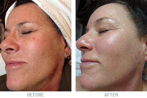 Microdermabrasion & Chemical Peels | Natural Skincare Clinic
