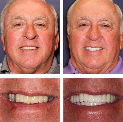 snap  teeth  palm beach gardens fl pga dentistry