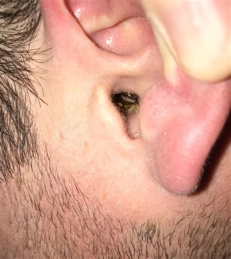 blackheads in ear
