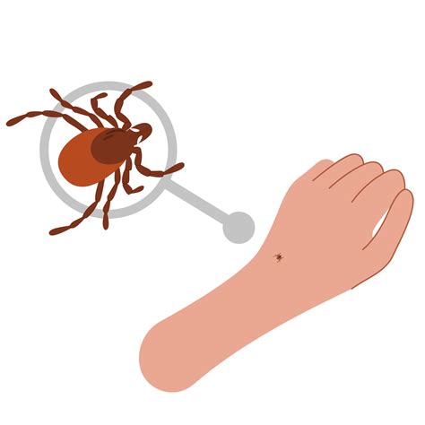 The human hand with the tick bite. Tick bite hand.Tick bite. Healthcare ...