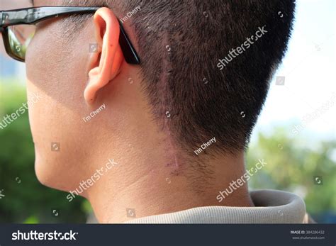 Scars Surgery Brain Tumors Stock Photo (Edit Now) 384286432