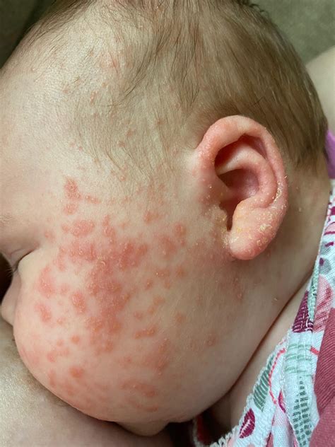 Baby Acne On Ears