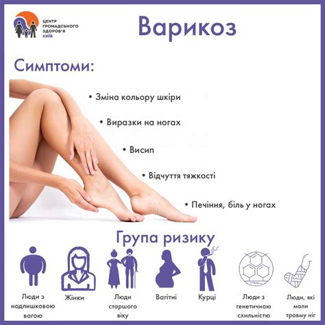 Варикозне розширення вен - Балтський центр ПМСД