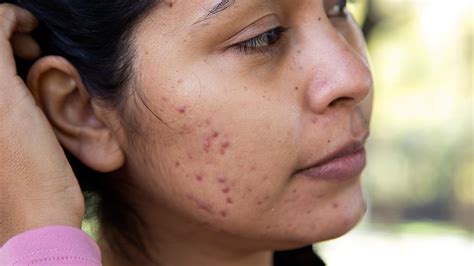Raised Skin Bumps: Pictures, Types, Causes, and Treatment