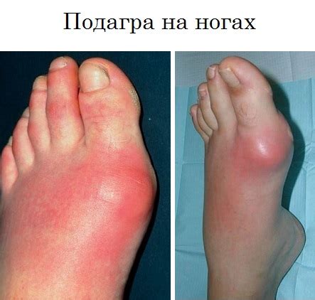 Подагра: признаки, симптомы и лечение, диета при подагре на ногах, фото