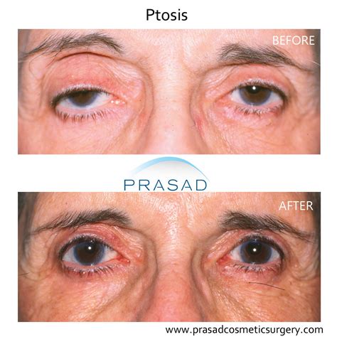 Ptosis Surgery Before And After Photos | Amiya Prasad MD FACS