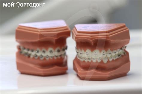 Самолигирующие брекеты | Клиника Мой Ортодонт