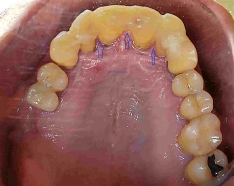 Dente Mole: O que é, Porque Ocorre, Tratamento e Prevenção