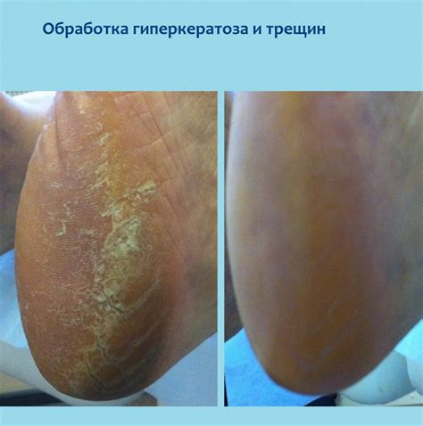 Гиперкератоз стоп - леченеи и обработка в СПб, цена, врачи
