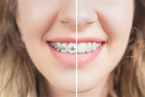 Lingual Brackets | Dentist Dartford | Cosmetic Dentist Crayford