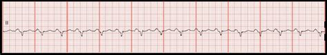 Practice EKG Rhythm Strips 139