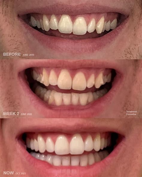 Souirensu It Works: My Before & After Photos Will SHOCK You! - 61wham7
