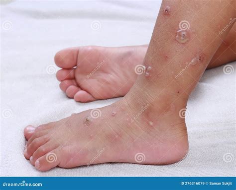 Hfmd Hand Foot Mouth Virus Red Blisters on Both Legs and Feet Epidemic ...