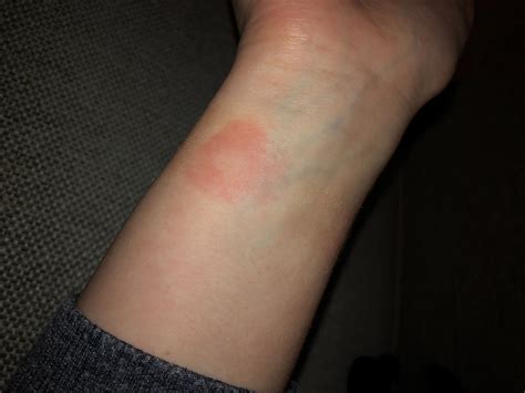 Apple Watch Rash Pictures - ios