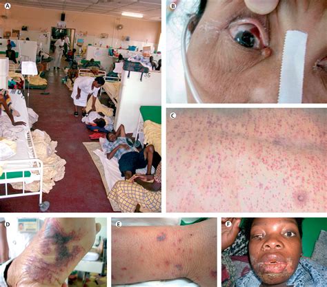 Meningitis Facts Viral Meningitis Meningitis Severe H - vrogue.co
