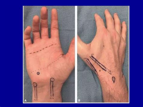 Chronic Wrist Pain And Examination | PPTX