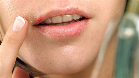 blisters  lips allergic reaction